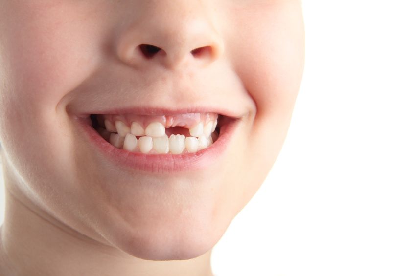 Photo of child's mouth with missing front teeth